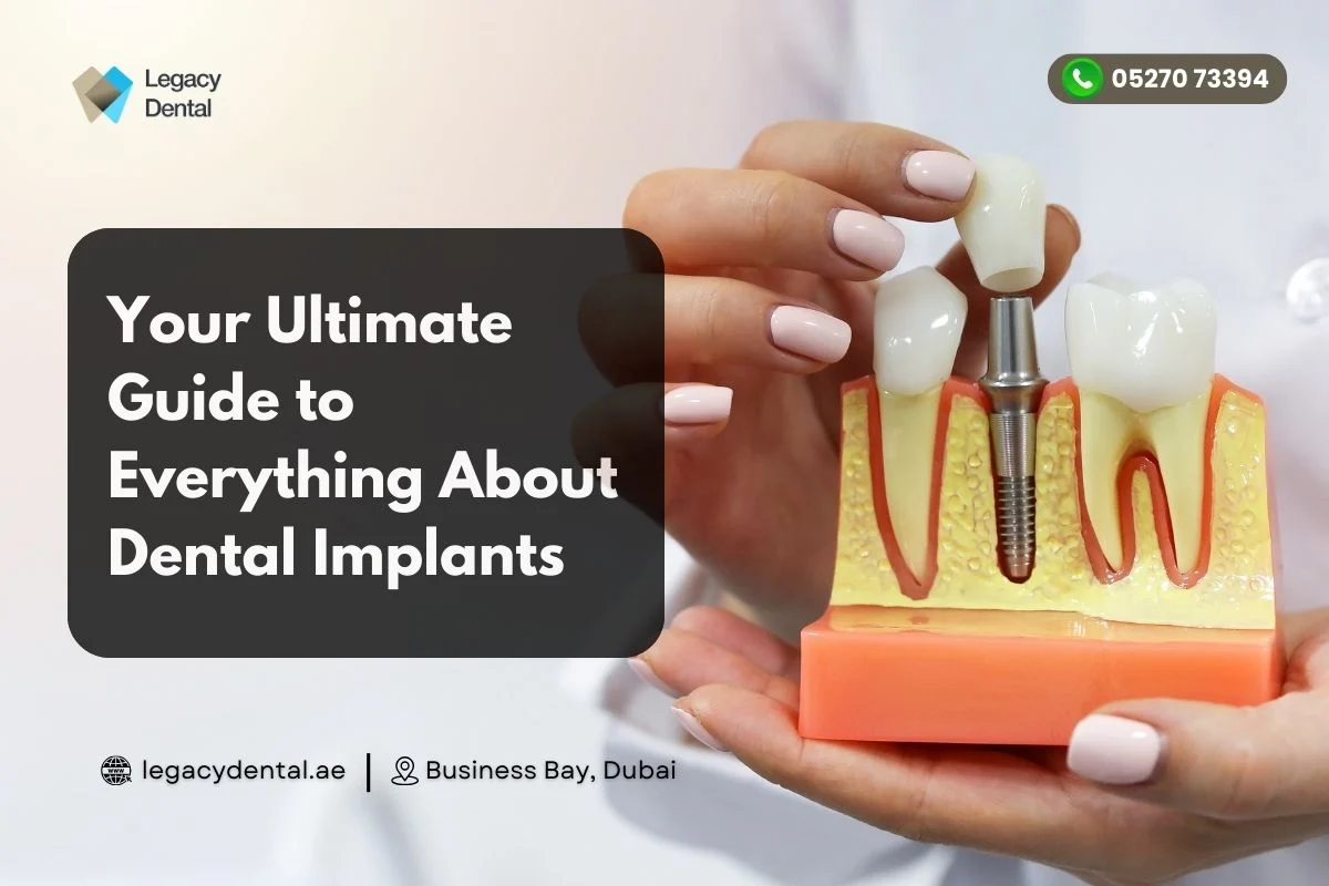 Your Ultimate Guide to Everything About Dental Implants - Legacy Dental ...